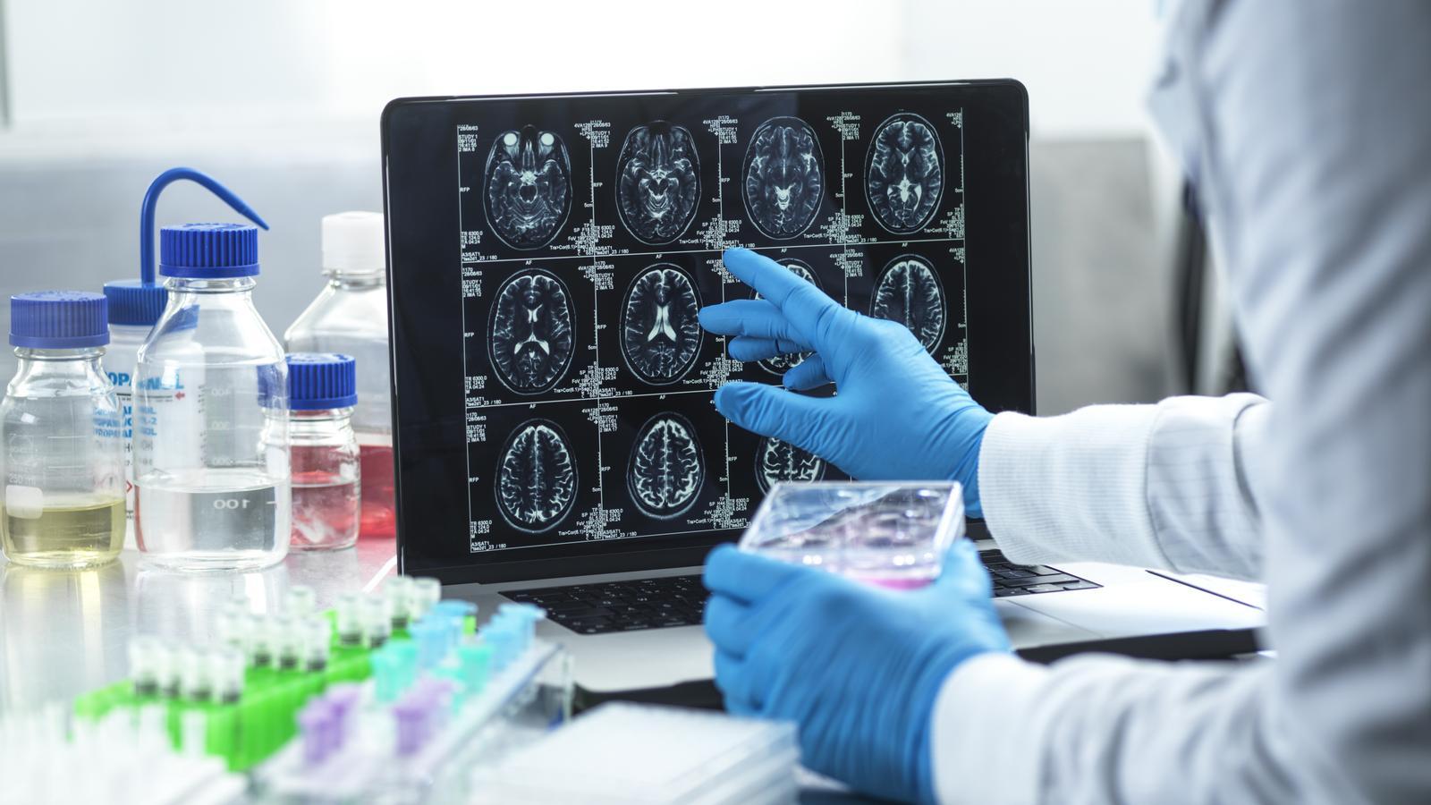 Alzheimer'daki Umut Veren Gelişmeler Parkinson İçin Yeni Bir Çağ Başlatıyor