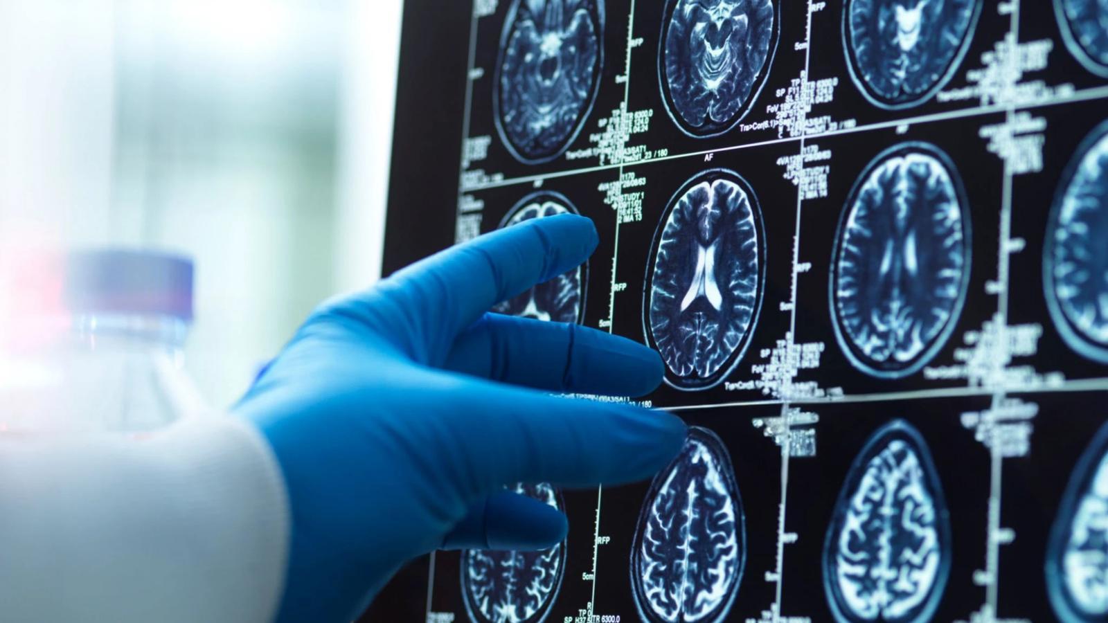 Alzheimer'ın Erken İzleri: Roman Analizinden Akıllı Telefonlara Uzanan Bilimsel Yolculuk